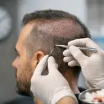 Quanto dura un trapianto capelli? Tempi reali